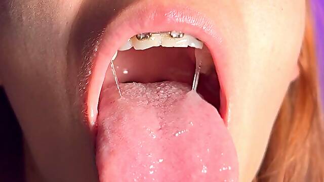 Braces Mouth Fetish
